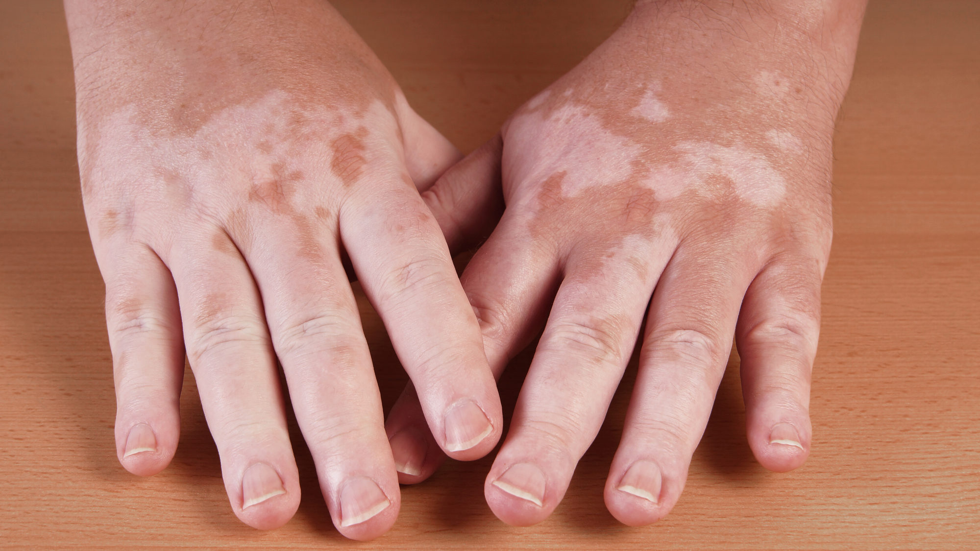 vitiligo hands Витилиго на руках